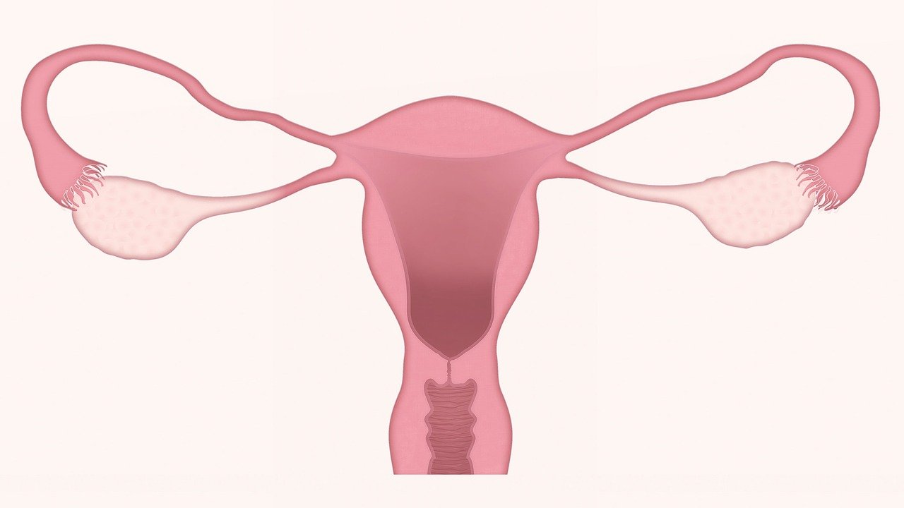 petefészek endometriózis meddőség ciszta